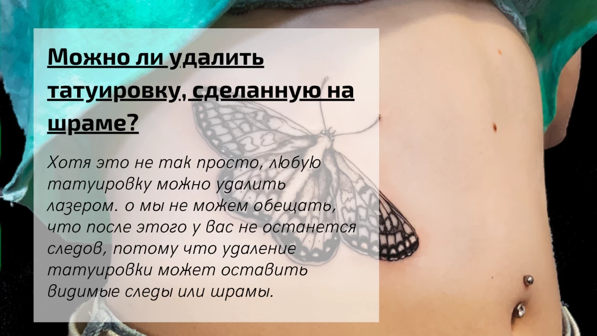 Can I remove a tattoo on my scar